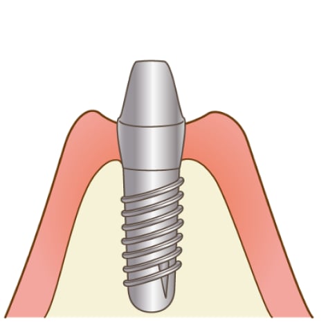 STEP3 ２次手術（新しい歯を装着する準備の手術）